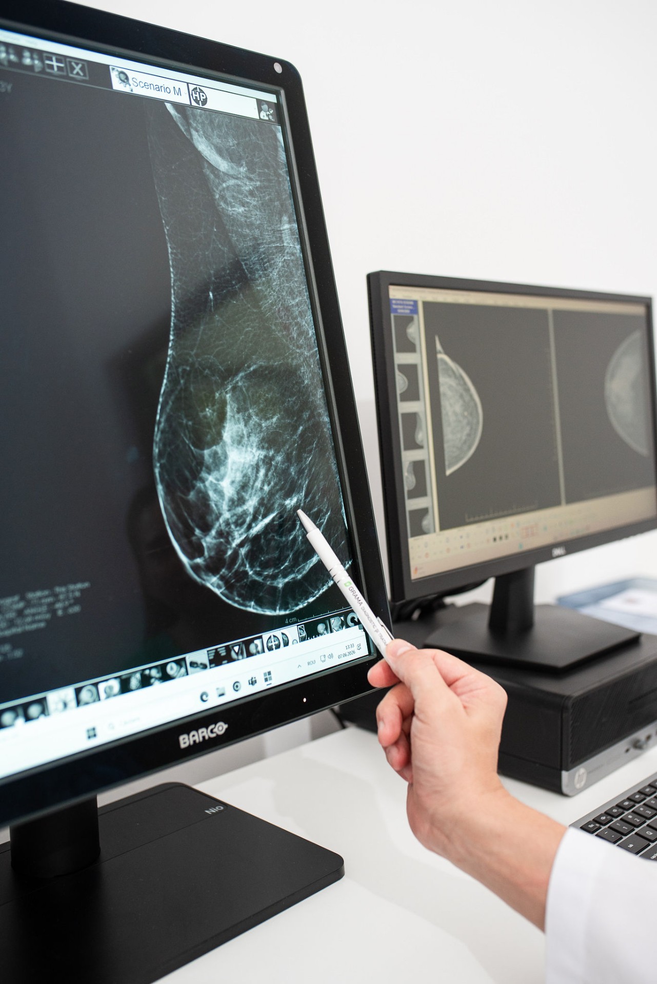 Interpretare imagine mamografică pe monitor diagnostic Barco - Clinica GRAMA